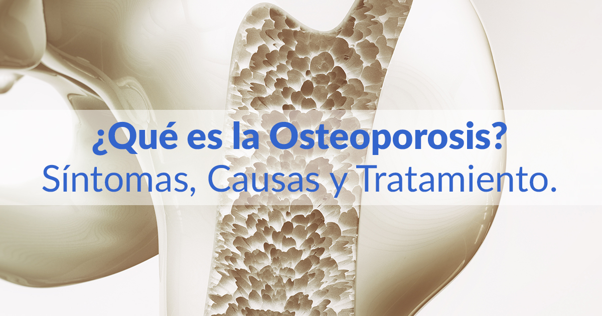 Qué es la Osteoporosis Conóce los síntomas y el tratamiento