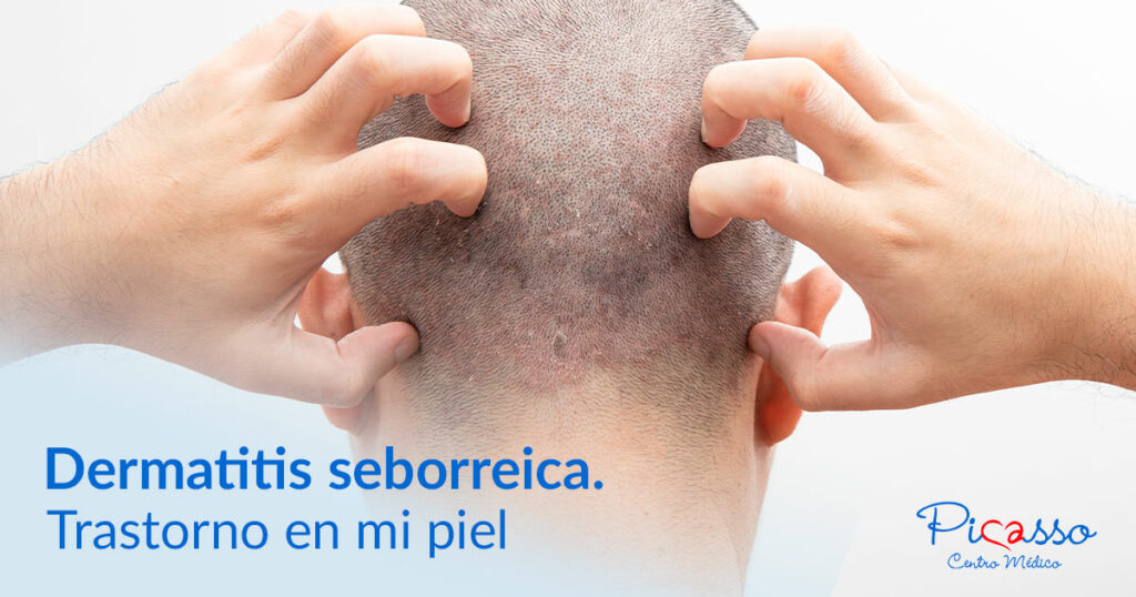 Dermatitis seborreica: tratamiento para cara y cuero cabelludo